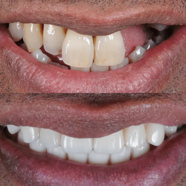 Top Options for Repairing a Broken Tooth