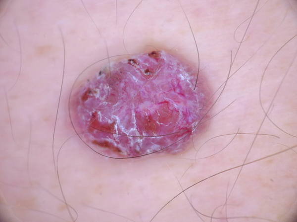 Advancements in Melanoma Detection and Treatment