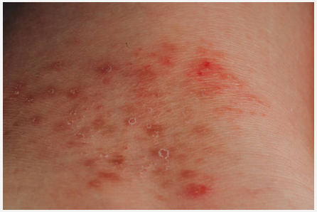 Exploring Conditions Treated by General Dermatology