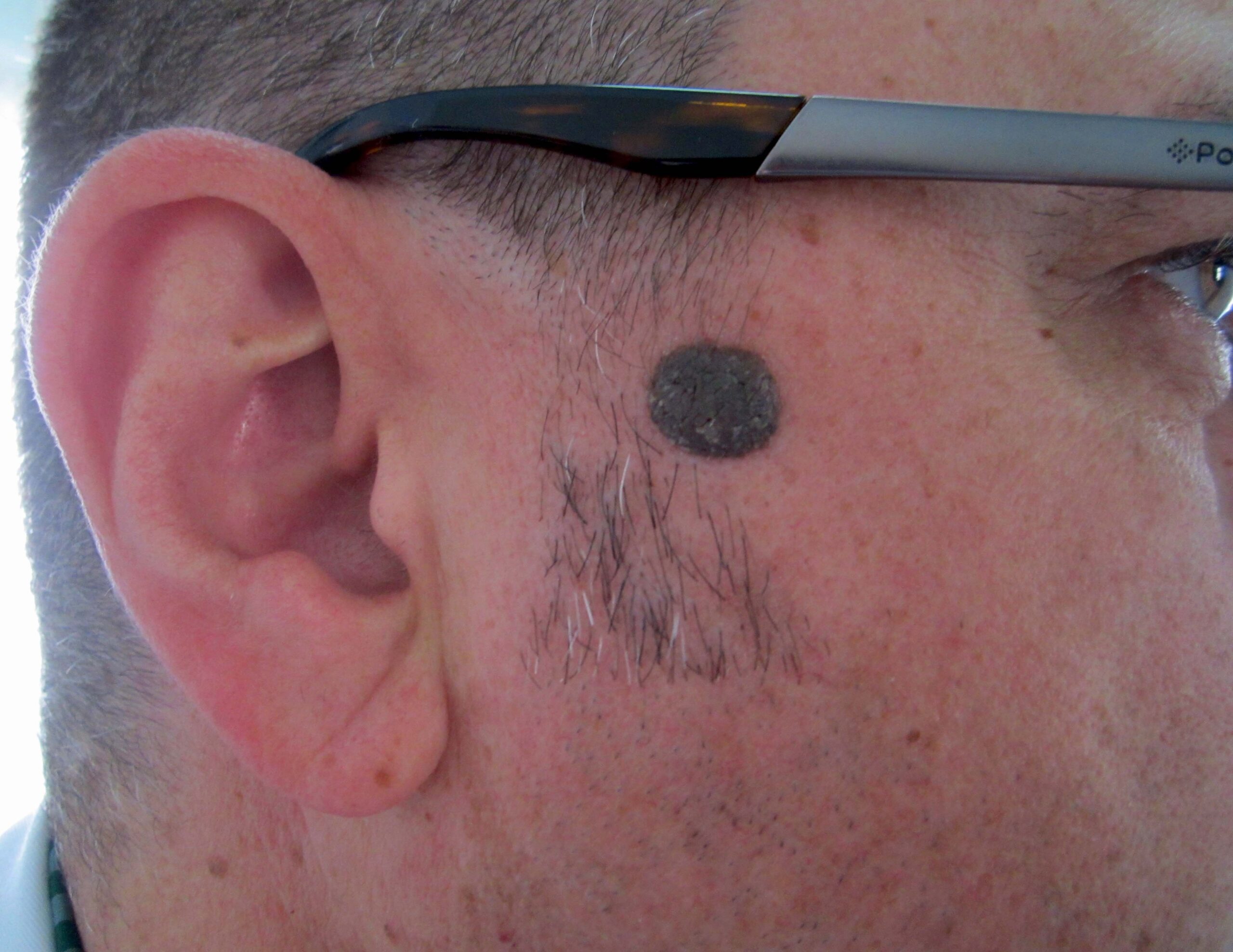 Five Signs a Mole May Be Cancerous