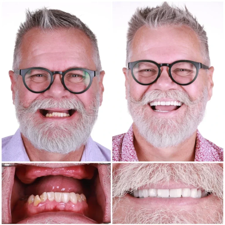 How Dental Implants Can Help Restore Confidence in Your Smile