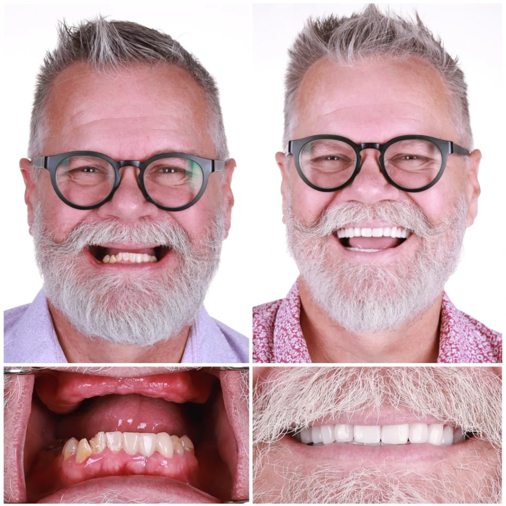 How Dental Implants Can Help Restore Confidence in Your Smile