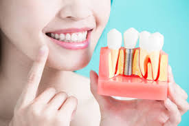 How an Implant Specialist Can Help You Achieve a Natural-Looking Smile